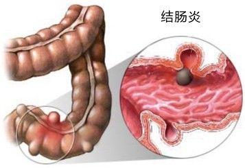 出血性结肠炎