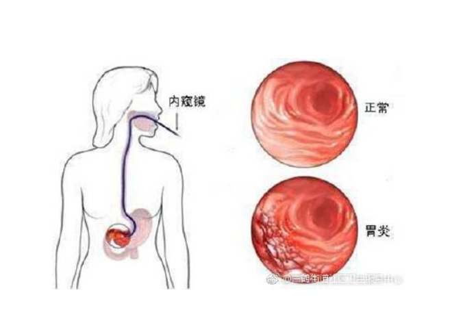 萎缩性胃炎