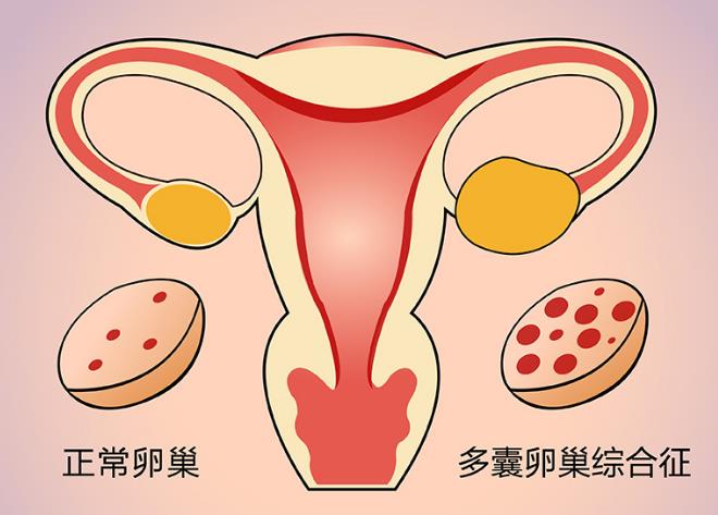 多囊卵巢综合征