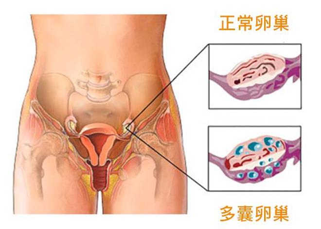 多囊卵巢综合征