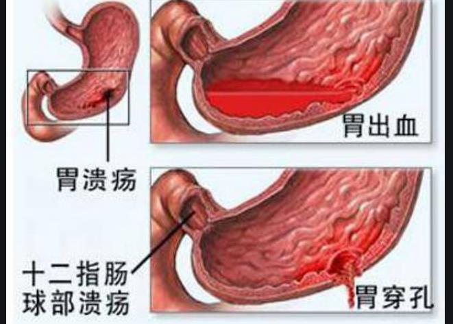 消化性溃疡