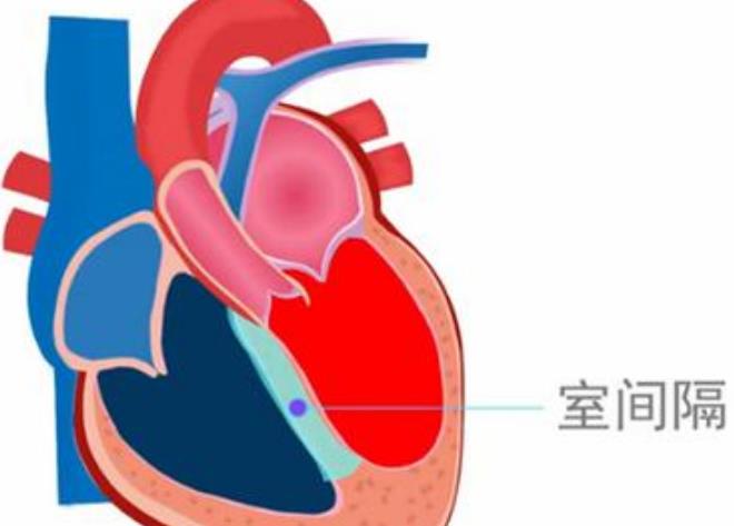 室间隔缺损