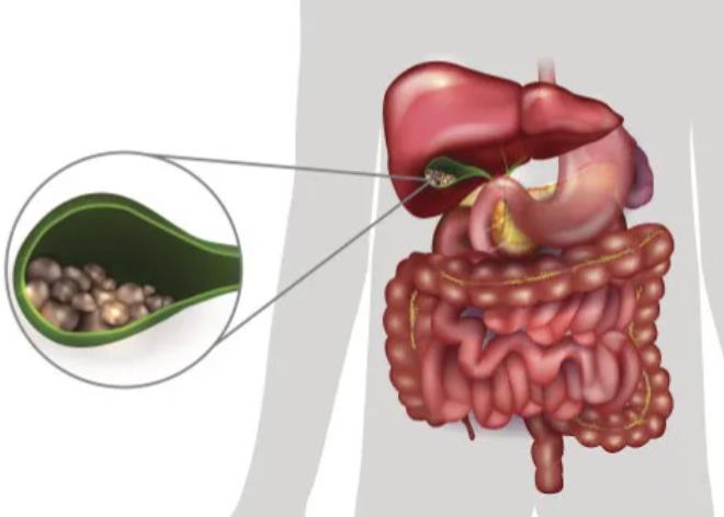 胆囊结石